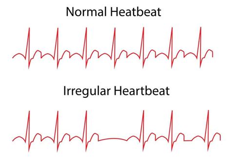 Heart Arrhythmias Types Causes And Prevention Healthtian