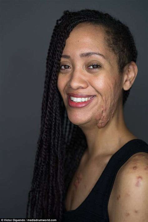 Woman Taunted By Bullies Over Her Skin Shows Off Her Facial Scars
