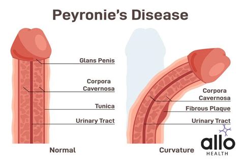 What Is Peyronies Disease Allo Health