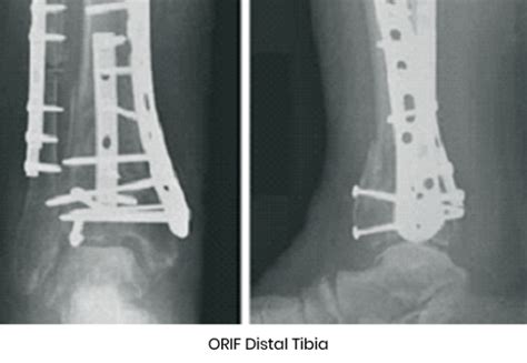 Tibial Plafondpilon Fractures Dr Warren