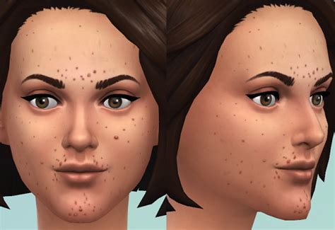 Mild Acne Sims 4 Skins