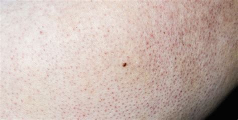 Skin Bumps Keratosis