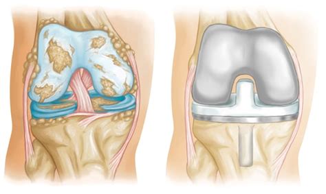 Knee Replacement Surgery In Pinehurst Nc John Moore Iv Md