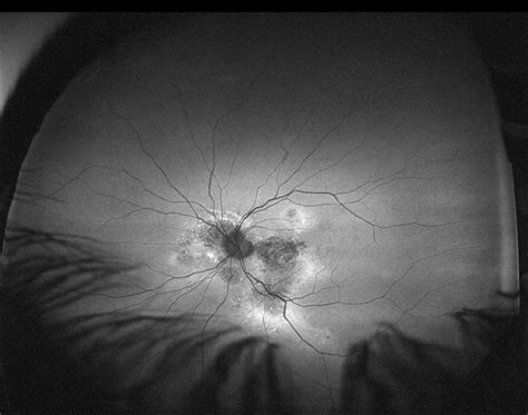 Chronic Central Serous Chorioretinopathy Le Af Retina Image Bank