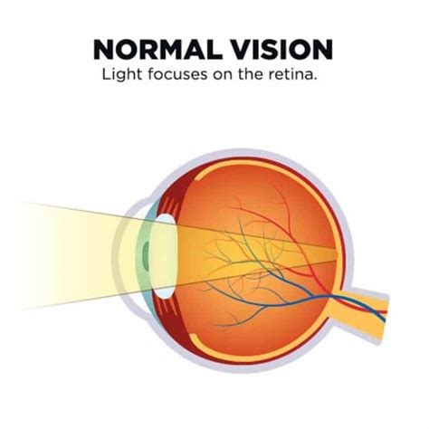Top 5 Causes Of Blurred Vision Symptoms And Treatment Simvey