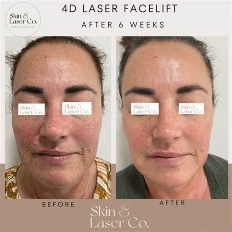 Fotona 4d Non Surgical Facelift Skin Laser Co