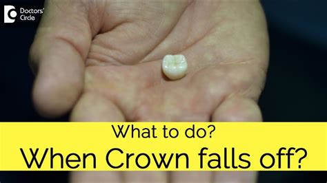What Do I Do If My Crown Falls Off After Rct Dr Manesh Chandra