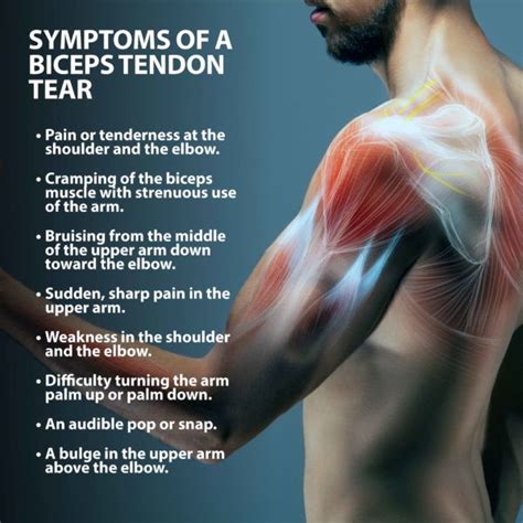 Bicep Tendon Tear Info Florida Orthopaedic Institute