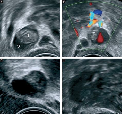 Blood Clot In Leg Ultrasound