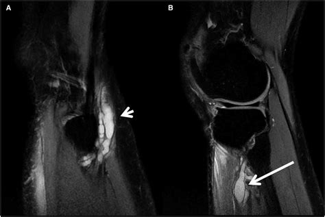 Intraneural Ganglion Cysts Of The Fibular Nerve A Cause Of Fluctuating