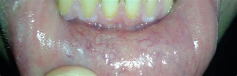 Oral Cancer White Spots On Gum