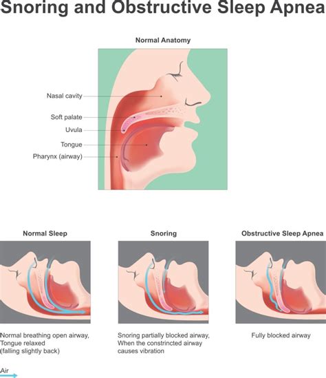 What You Should Know About Sleep Apnea Houston Physicians Hospital