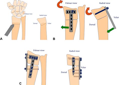 Orthogonal Plate Fixation With Corrective Osteotomy For Treatment Of