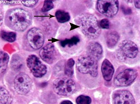 Histopathology Images Of Diffuse Large B Cell Lymphoma Nos By