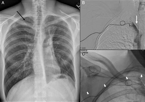 Spontaneous Coiling Of A Peripherally Inserted Central Venous Catheter