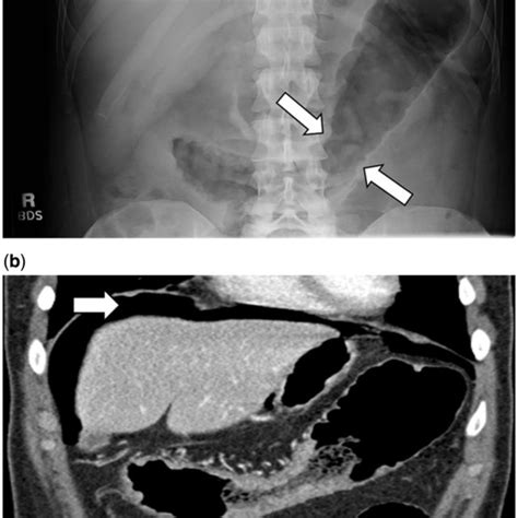 Double Contrast Barium Enema Illustrating Granular Mucosa In A Patient
