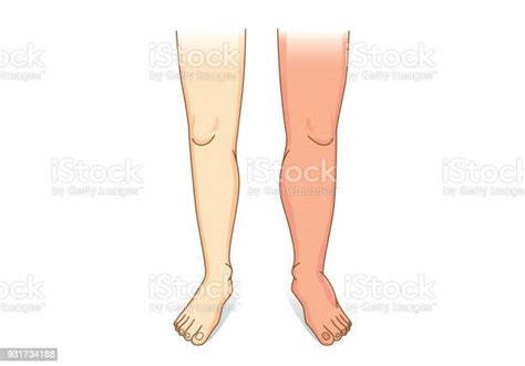human leg swelling in front view stock illustration download image now retention liquid
