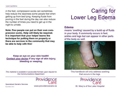 Caring For Lower Leg Edema Handbook Providence Care By Providence