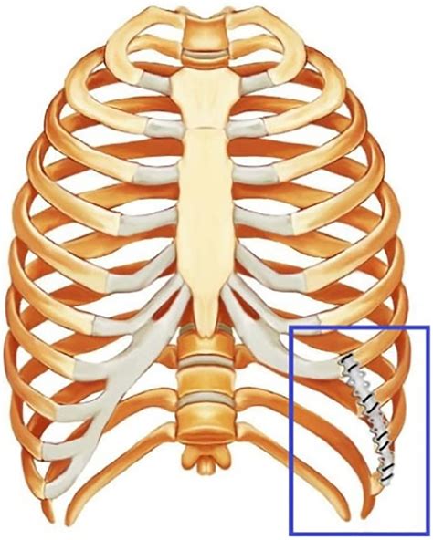 Vertical Rib Plating For The Treatment Of Slipping Rib Syndrome