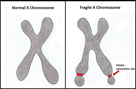 Signs And Symptoms Of Fragile X Syndrome Autistic Advisor