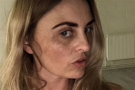 Ex Model Who Faked Depression For £7k Nhs Nose Job