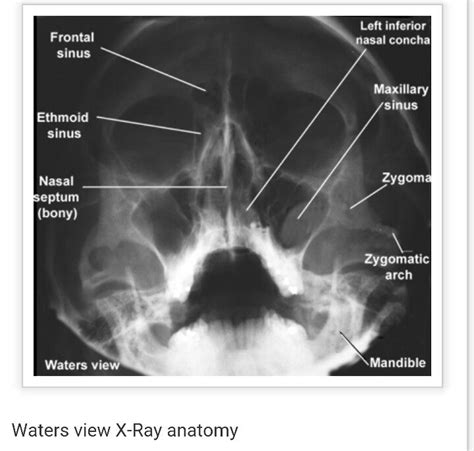 Waters View Radiology Imaging Radiology X Ray