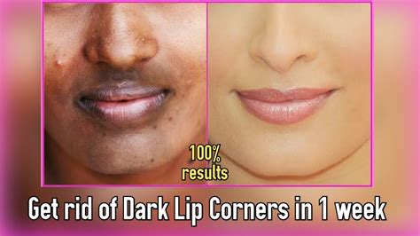 How To Remove Dark Corners Of Lips