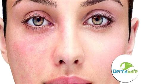 💥 How To Soothe Irritated Skin On Face Sensitive Skin Types Often