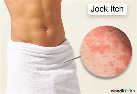 Jock Itch Causes Symptoms And Medical Treatment