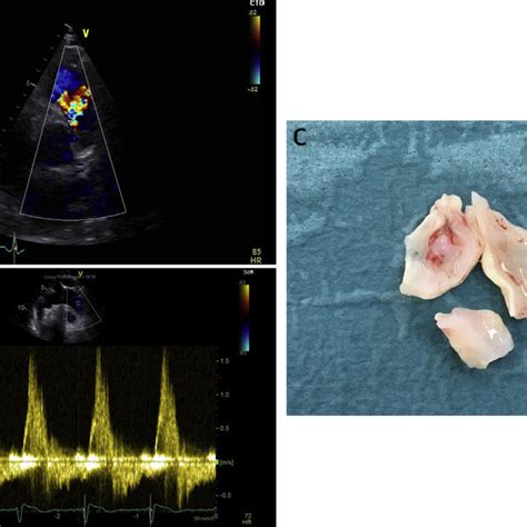 Pdf Quadruple Bioprosthetic Valve Replacement In A Patient With