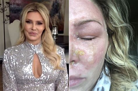RHOBH S Brandi Glanville Reveals Facial Burn Horror After Psoriasis Light Accident Irish