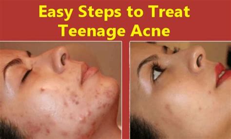 8 Easy Steps To Treat Teenage Acne Permanently At Home