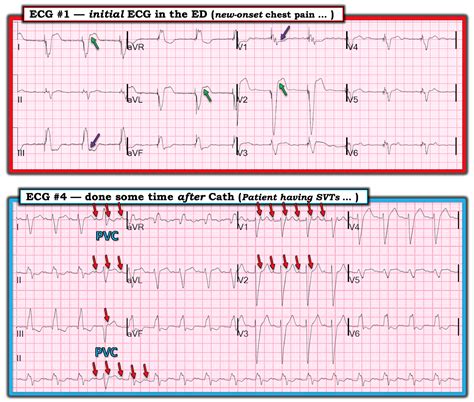 Dr Smiths Ecg Blog Acute Chest Pain In A Patient With Cardiomyopathy