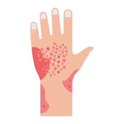 Rash Vector Rash Itchy Hand Png And Vector With Transparent