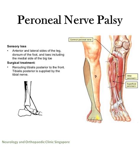 Common Peroneal Nerve Palsy And Physiotherapy Treatment Dermatomes