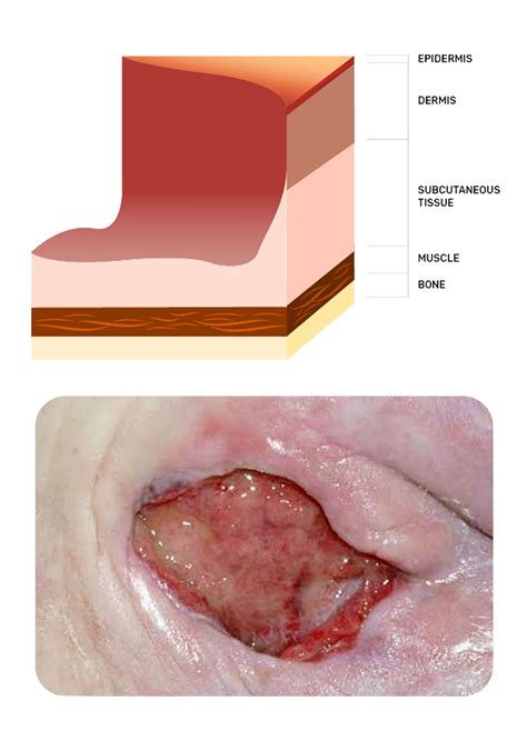 Stage 3 Pressure Ulcer 1 This Wound Often Includes Undermining And