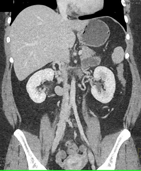 Calcified Right Adrenal Gland Due To Prior Trauma Adrenal Case