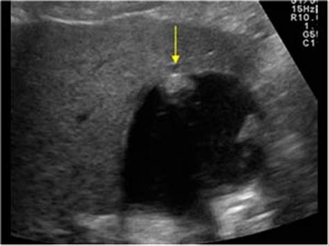 Abdomen And Retroperitoneum 12 Gallbladder And Bile Ducts Case 12