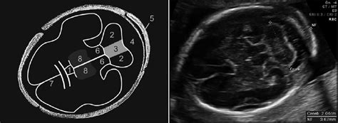 Fetal Head Ultrasound