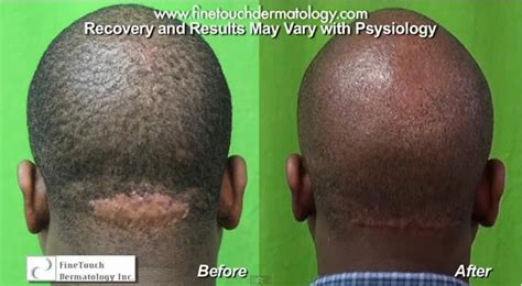 Nape Of Head Acne Keloidalis Nuchae Treatment By Dr Umar