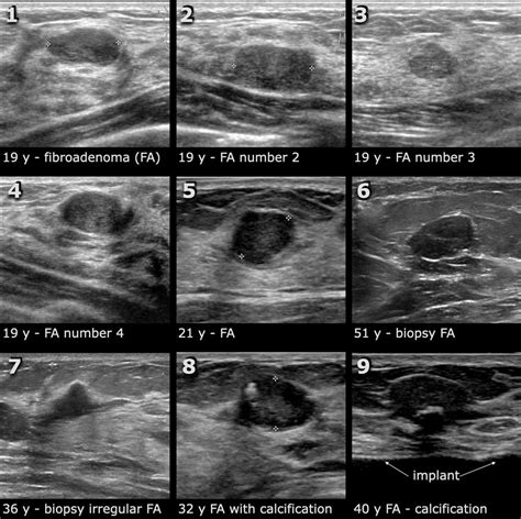 Breast Cancer Classification With Ultrasound Images Based On Slic