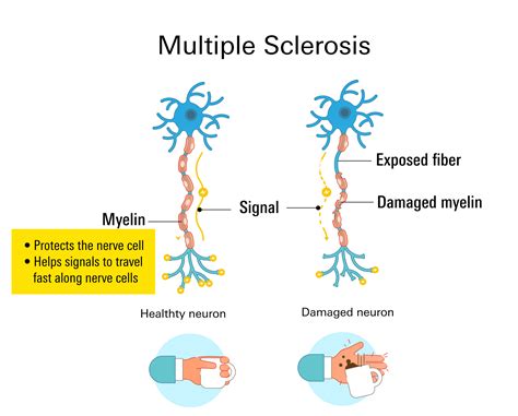 Multiple Sclerosis Ms