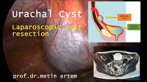 Urachal Cyst Laparoscopic Resection Metin Ertem Mdfacs Youtube