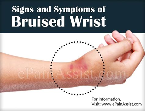 Bruised Wrist Wrist Contusion Causes Symptoms Treatment Test Diagnosis
