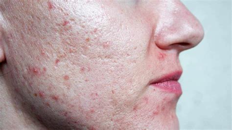 7 Habits That Cause Acne Scarring And What To Do Instead