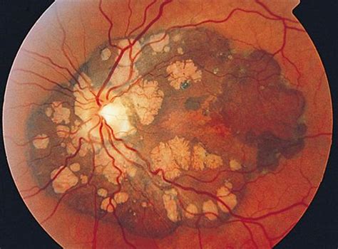Progression Of Papillomacular Congenital Hypertrophy Of The Retinal