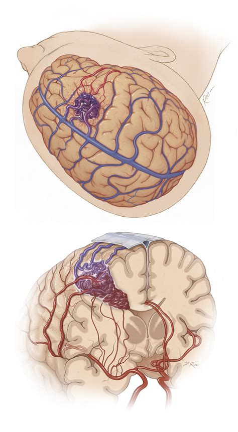 Frontal Avms The Neurosurgical Atlas