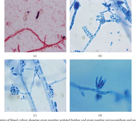 Pdf Fatal Disseminated Fusarium Infection In A Human Immunodeficiency