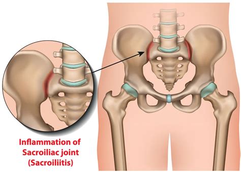 Sacroiliac Joint Injection Excel Pain And Spine