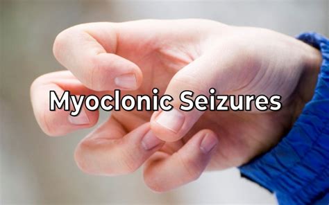 Myoclonic Seizures And Epilepsy Overview Epilepsyu